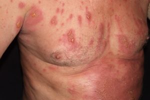 L57.8 002 Fitofotodermatitis; placas eritematoedematosas con vesículas y ampollas que siguen trayactos lineales