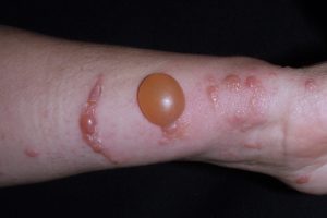 L57.8 005 Fotofitodermatitis; lesiones eritematosas y vesiculosas lineales en el antebrazo en un paciente recolector de higos