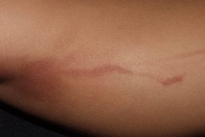 L57.8 Fitofotodermatitis; máculas hiperpigmentadas que siguen trayactos lineales. Ausencia de fase inflamatoriaL57.8 Fitofotodermatitis; máculas hiperpigmentadas que siguen trayactos lineales. Ausencia de fase inflamatoria