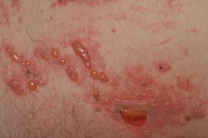 L57.8 002 Fitofotodermatitis; placas eritematoedematosas con vesículas y ampollas que siguen trayactos lineales