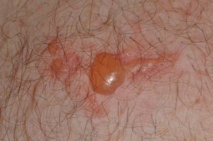 L57.8 Fitofotodermatitis; placa eritematosa con vesículas y ampollas que siguen trayactos lineales